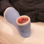 A periwinkle blue fiberglass cast on a man with a broken ankle and a torn ligament. Photo by Barbara Newhall